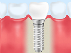 インプラント治療